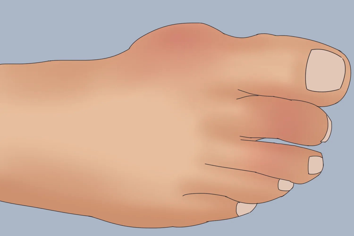 脚上痛风的位置示意图