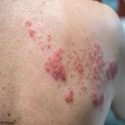 被虫子咬了起水疱怎么处理